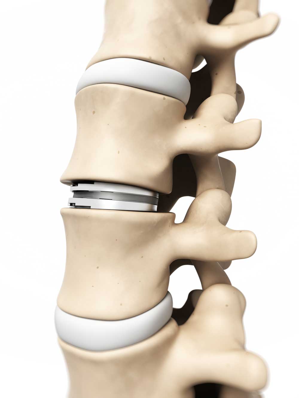 Artificial disc replacement in the neck