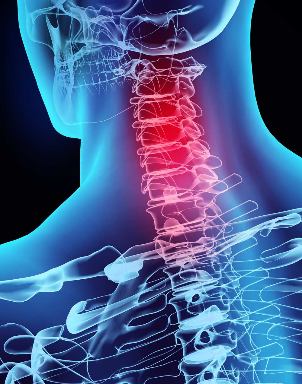 Cervical anterior microforaminomy