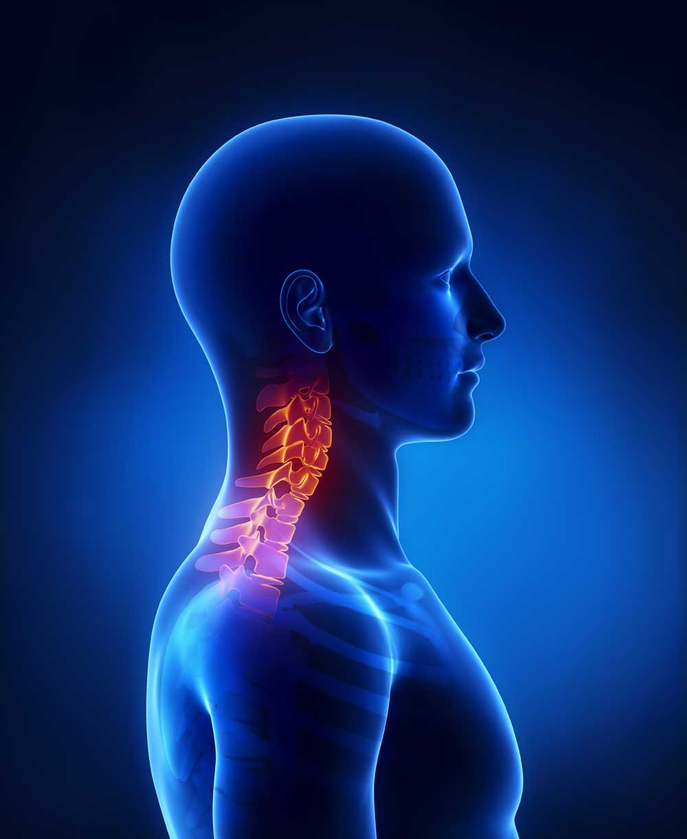 cervical spinal stenosis