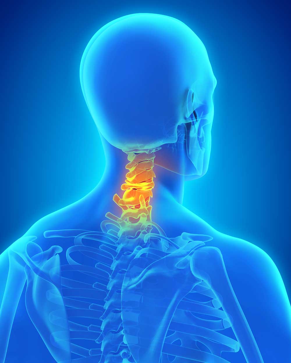 Cervical spondylotic myelopathy