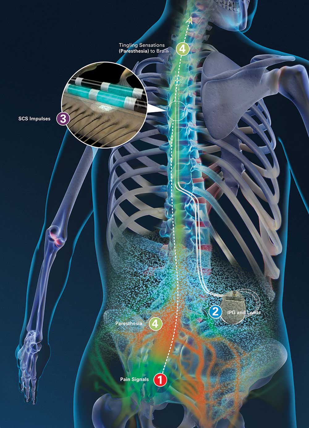 Spinal cord stimulator