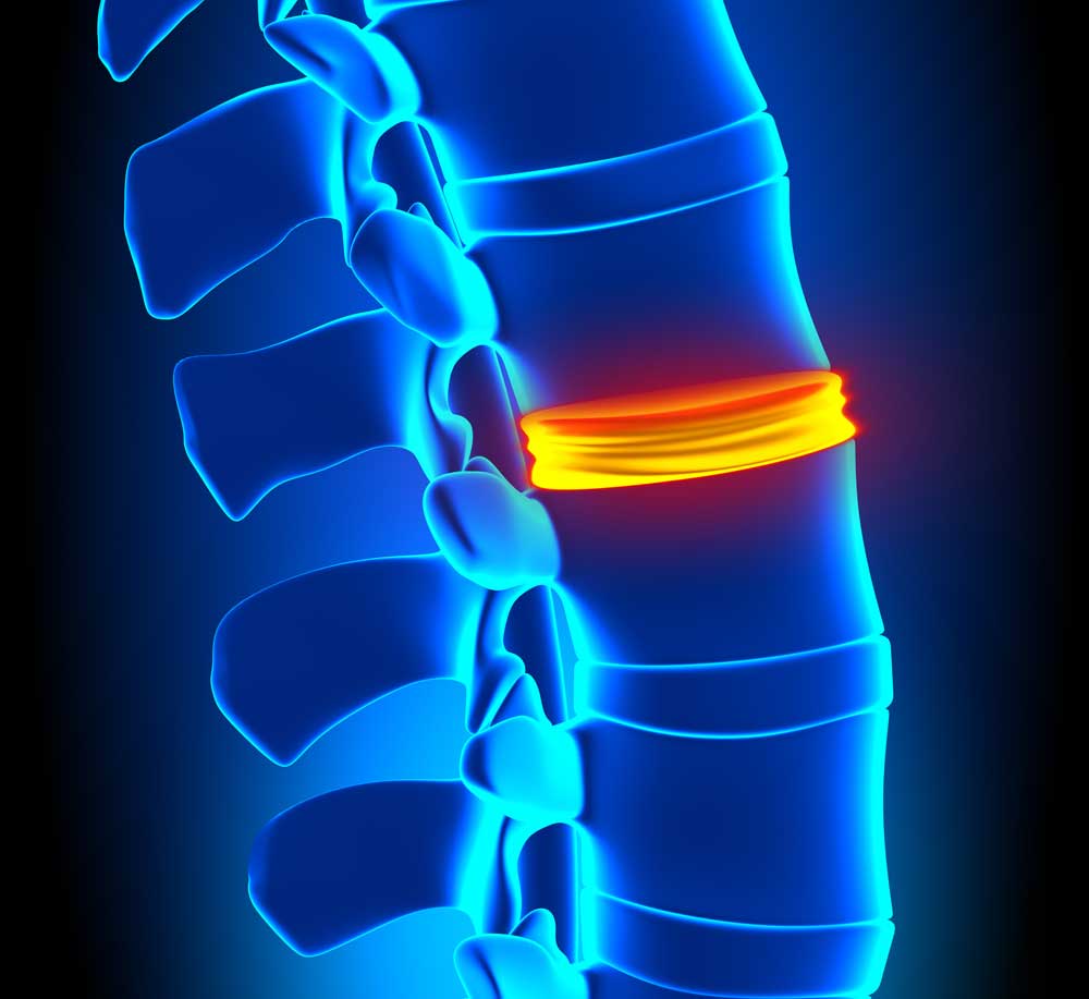 lumbar herniated disc