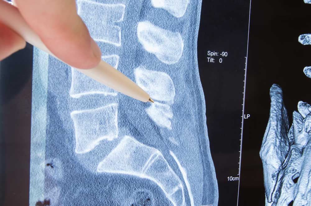 Lumbar spinal stenosis mri