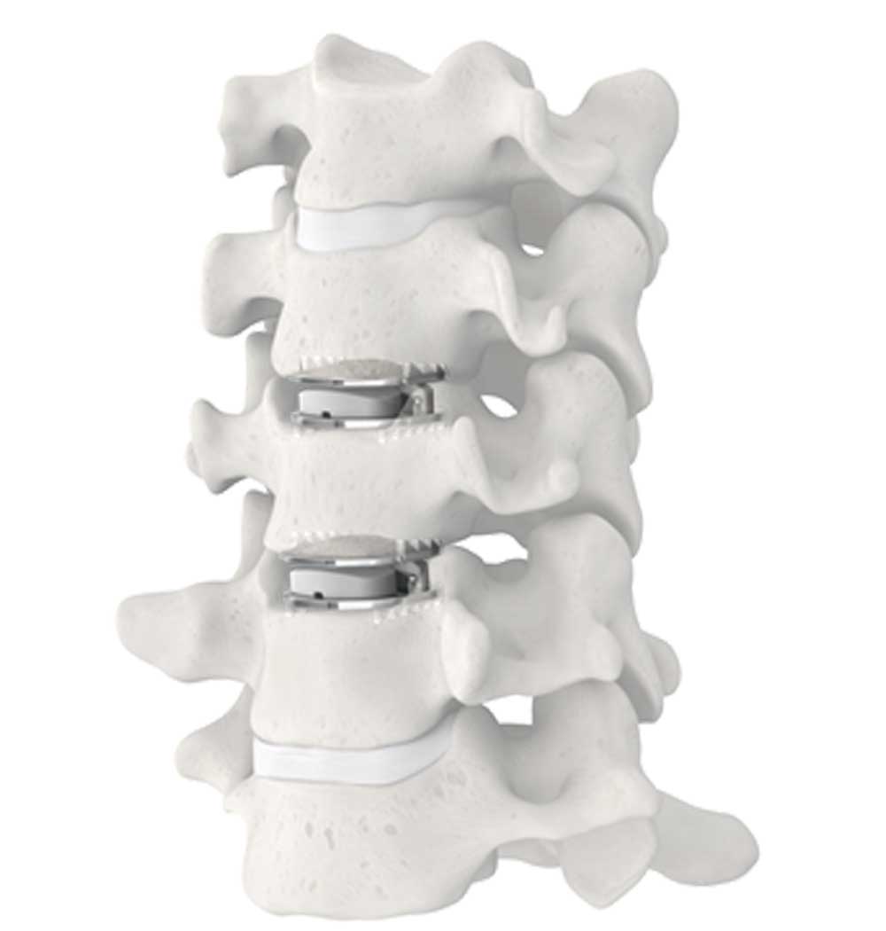 MobiC spine disc replacement