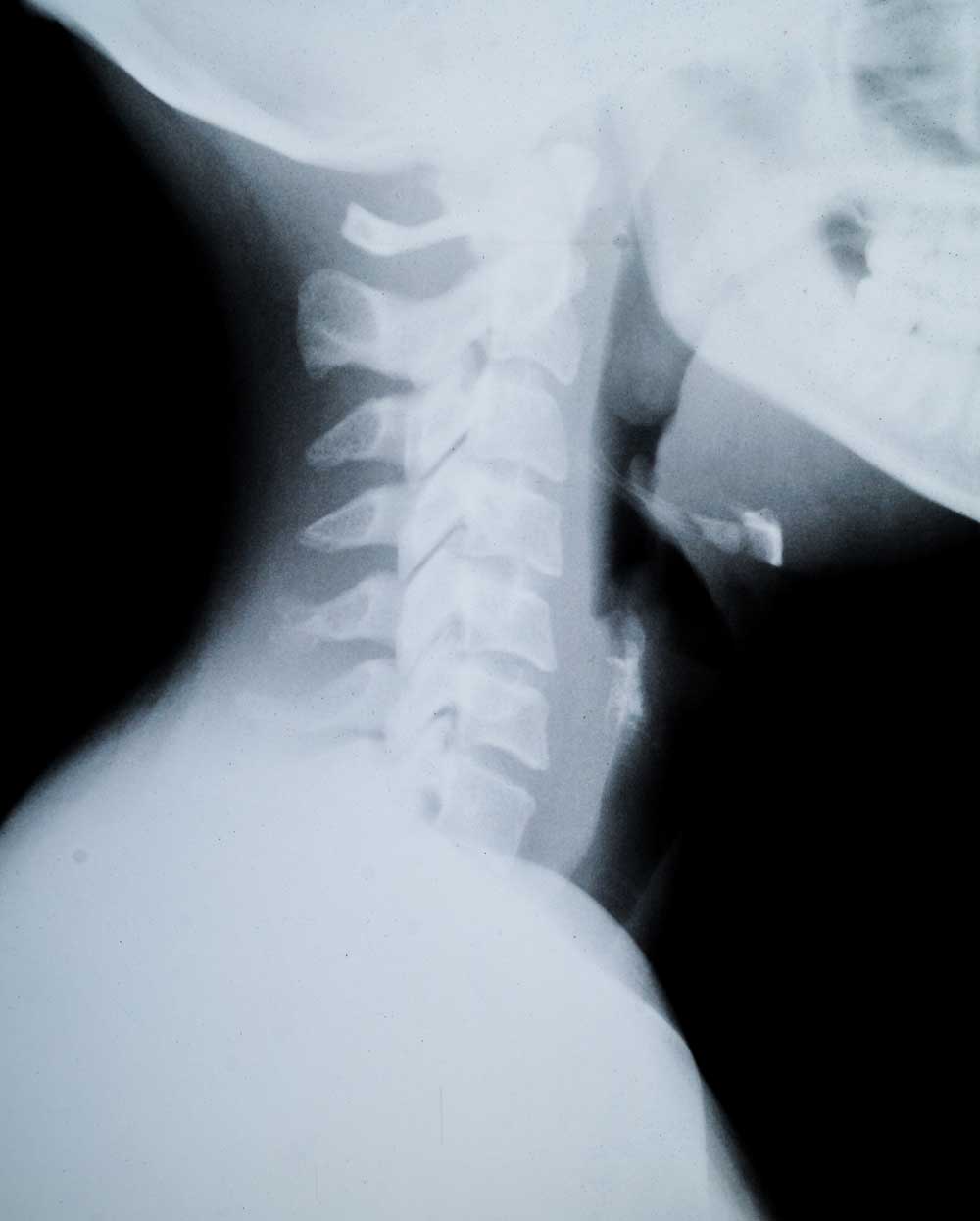 neck arthritis xray