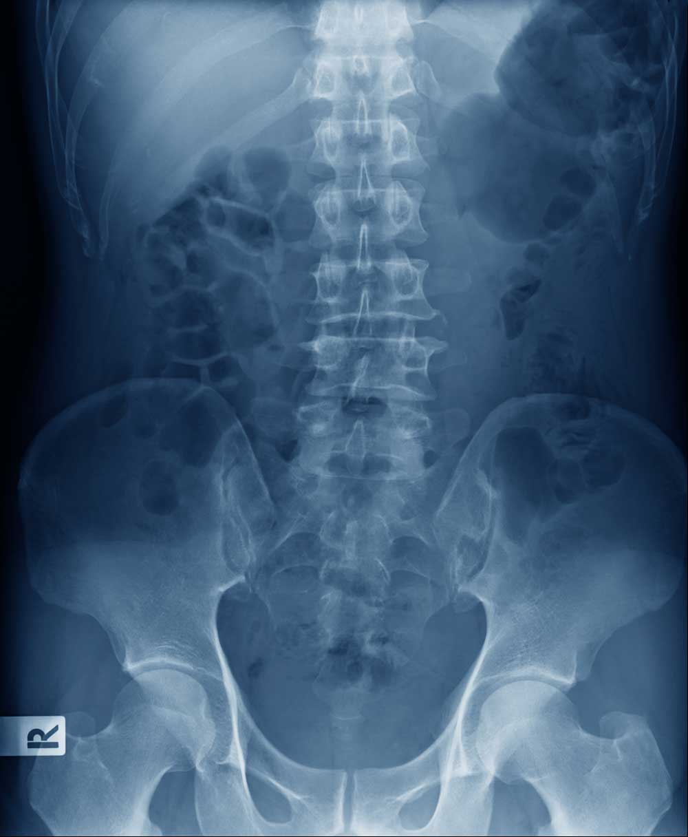 Posterior lumbar interbody fusion xray