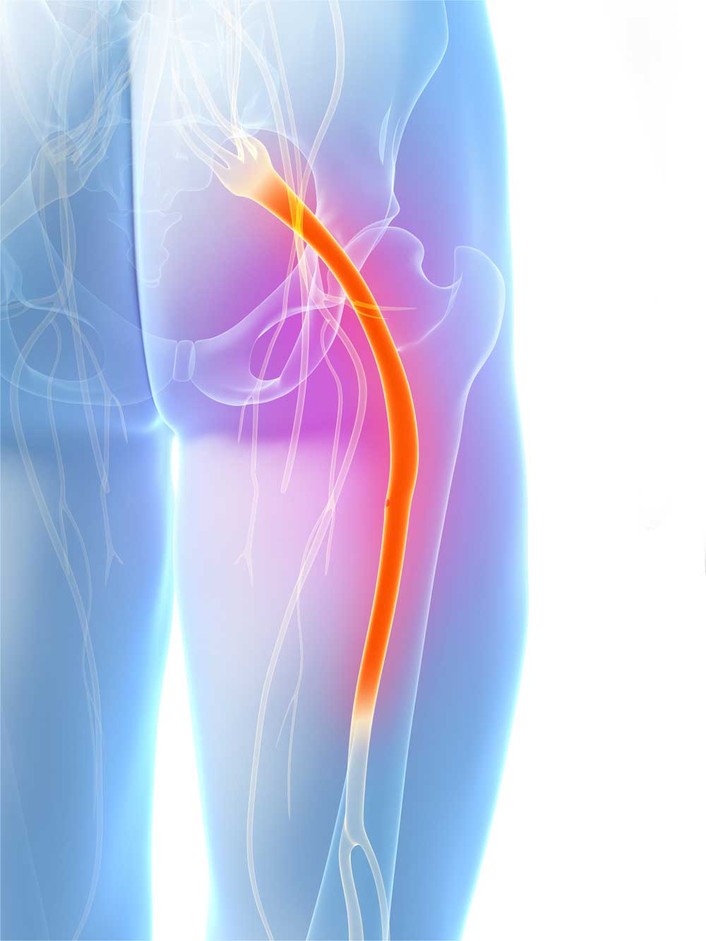 Sciatic leg pain