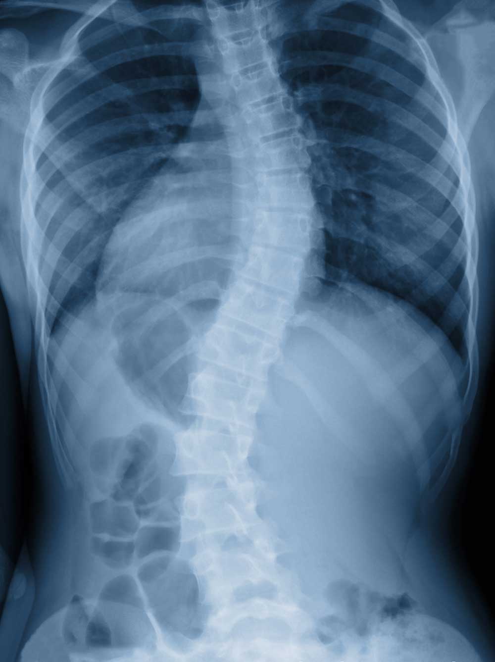 scoliosis xray