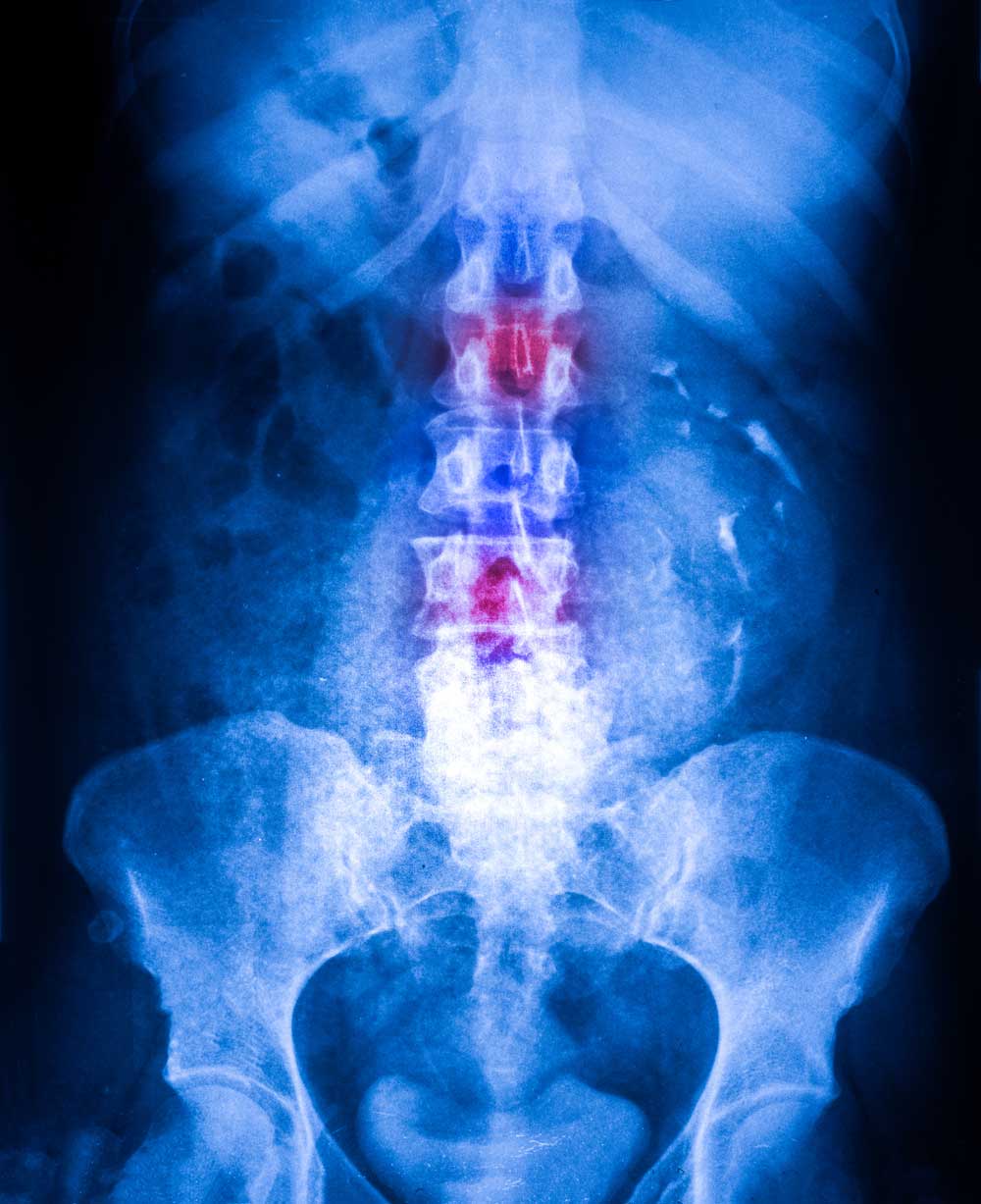 spianal tumors mri