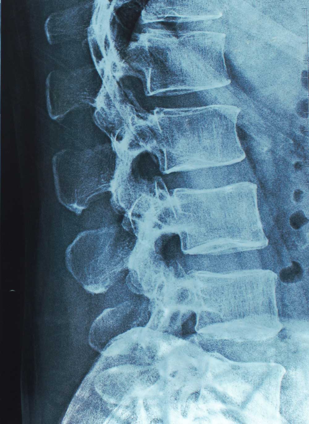 spine vertebrae xray