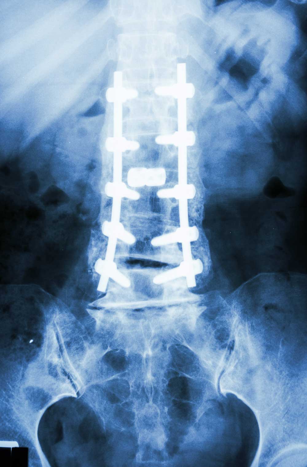 Spondylolisthesis surgery xray